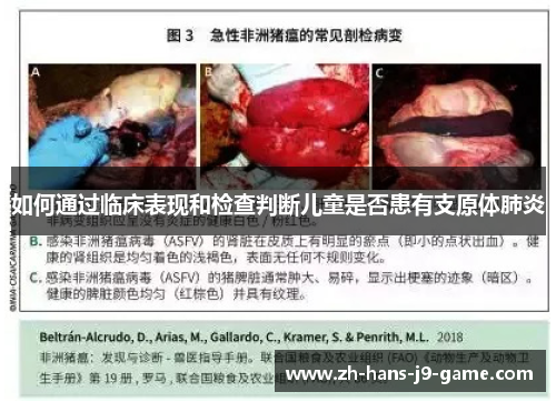 如何通过临床表现和检查判断儿童是否患有支原体肺炎 如何通过临床表现和检查判断儿童是否患有支原体肺炎